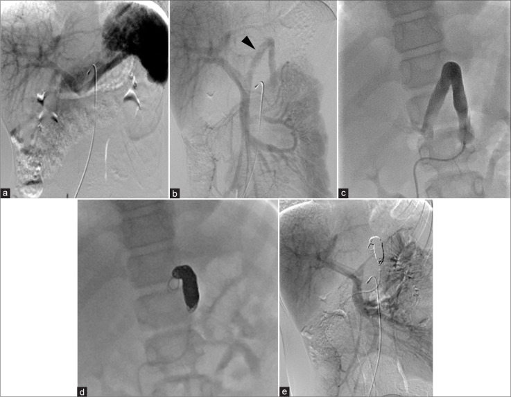 Long-term follow-up and transcatheter embolization of extrahepatic congenital portosystemic shunt with shifting hemodynamics.