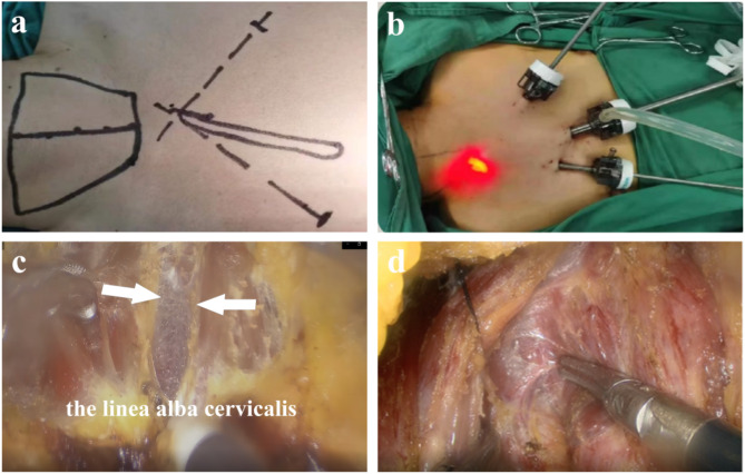 No closure of the linea alba cervicalis reduces complications in endoscopic thyroidectomy.