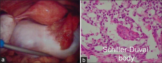 Successful Pregnancy after Fertility-sparing Surgery and Treatment for Metachronous Multiple Primary Malignancies - A Case Report.