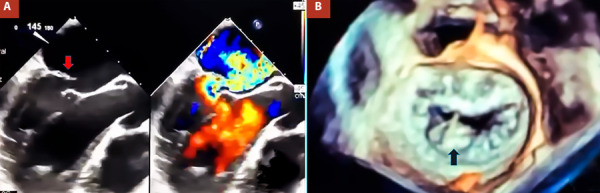 Totally endoscopic periareolar approach for mitral valve repair. First case reported in Peru.
