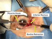 Outcomes of the intraoperative relaxed muscle positioning technique in strabismus surgery for thyroid eye disease.