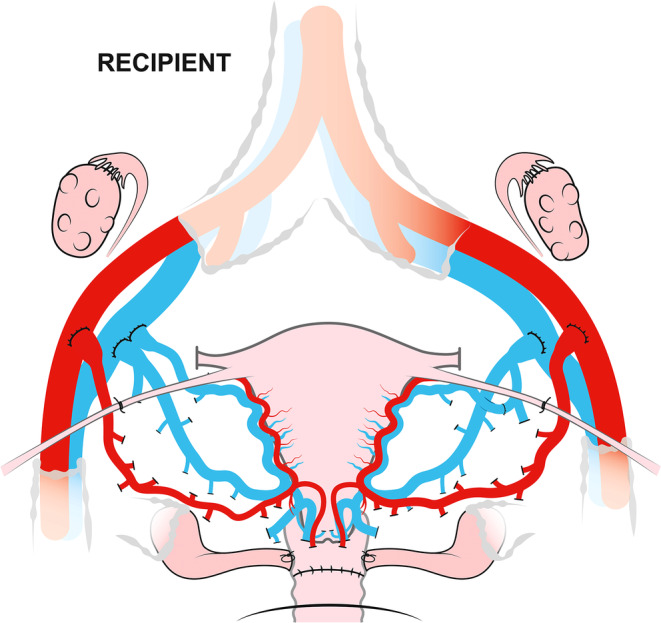 Uterus transplantation: A clinical breakthrough after systematic preclinical research.