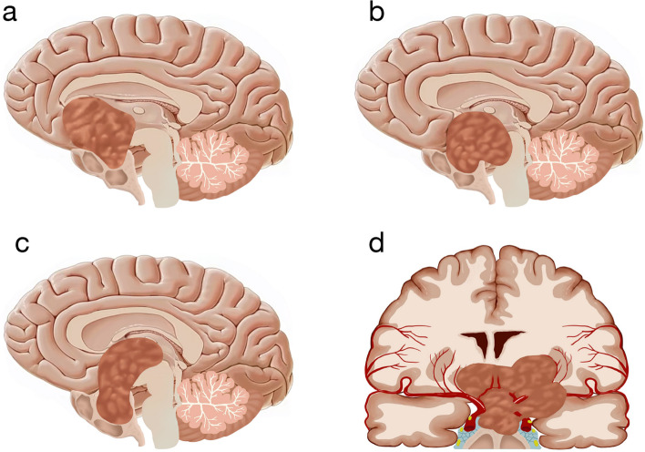 Giant and irregular pituitary neuroendocrine tumors surgery: comparison of simultaneous combined endoscopic endonasal and transcranial and purely endoscopic endonasal surgery at a single center.