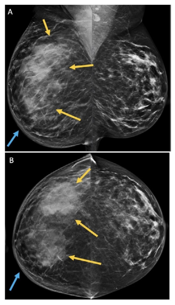 Uncommon Presentation of Metastatic Melanoma to the Breast.