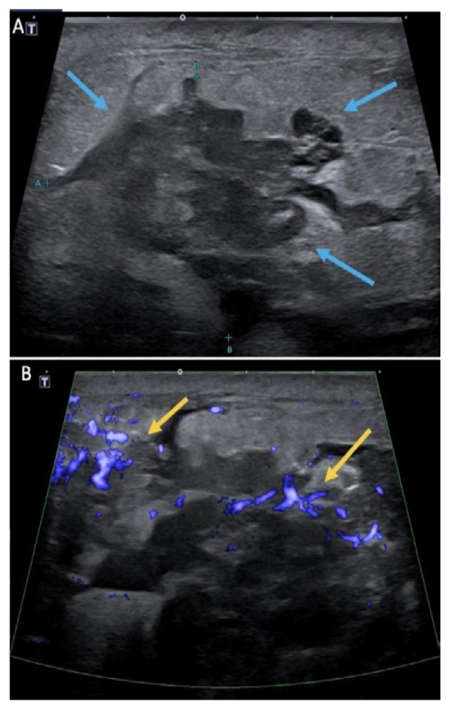 Uncommon Presentation of Metastatic Melanoma to the Breast.
