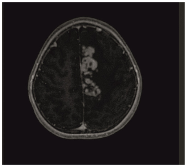 A rare and challenging pediatric case of drug toxicity and immune reconstitution inflammatory syndrome during the treatment of intracranial tuberculoma: A case report.