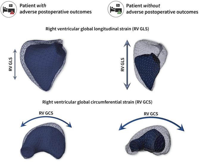 Impact of the right ventricular mechanical pattern assessed by three-dimensional echocardiography on adverse outcomes following cardiac surgery.