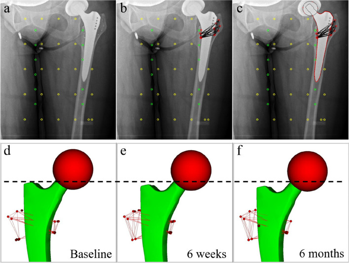 A high offset stem design does not increase stem migration under full weight bearing in cementless total hip arthroplasty: a model-based RSA study.