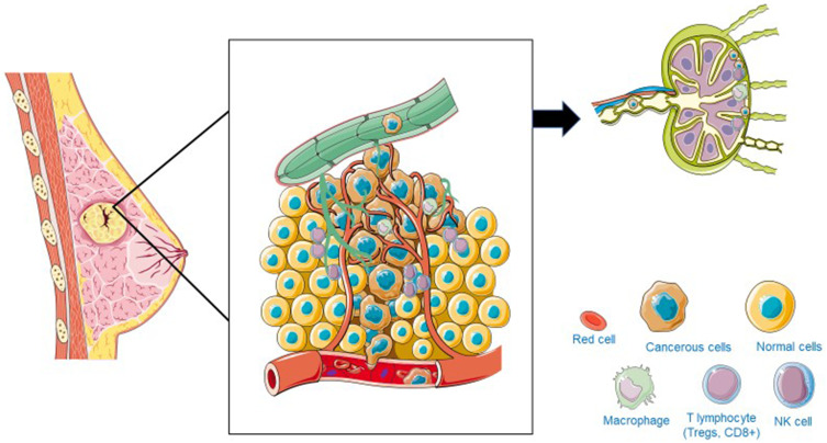 Molecular and Cellular Machinery of Lymphatic Metastasis in Breast Cancer.