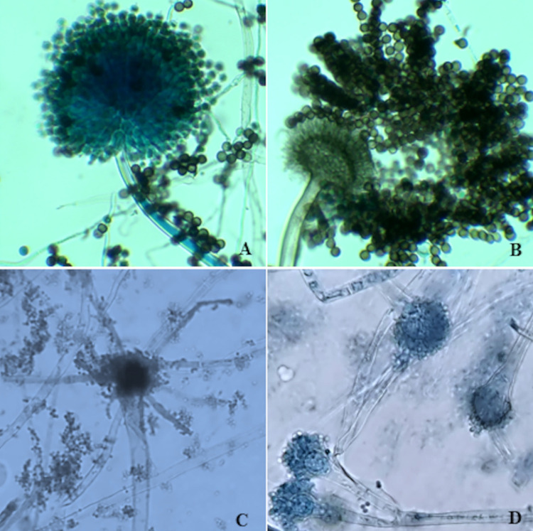 First documentation of Aspergillus welwitschiae in COVID-19-associated pulmonary aspergillosis in the Americas.