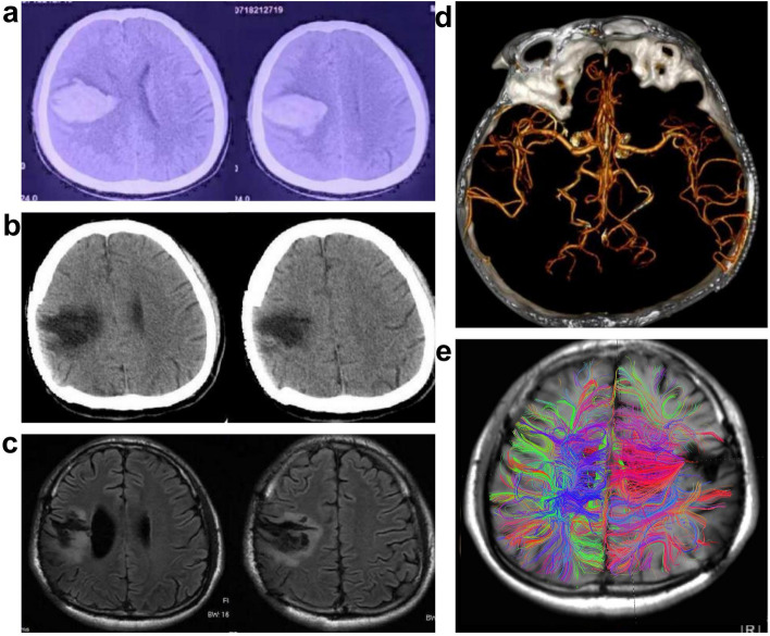 Vagus nerve stimulation combined with nerve rehabilitation therapy for upper limb paralysis after hemorrhagic stroke: a stroke-related epilepsy case.