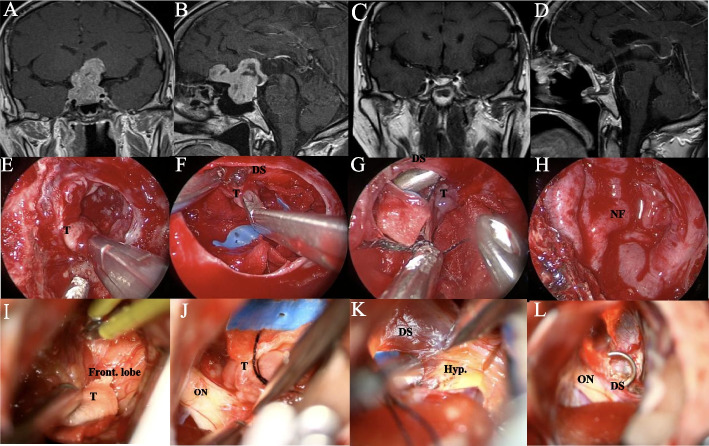 Giant and irregular pituitary neuroendocrine tumors surgery: comparison of simultaneous combined endoscopic endonasal and transcranial and purely endoscopic endonasal surgery at a single center.