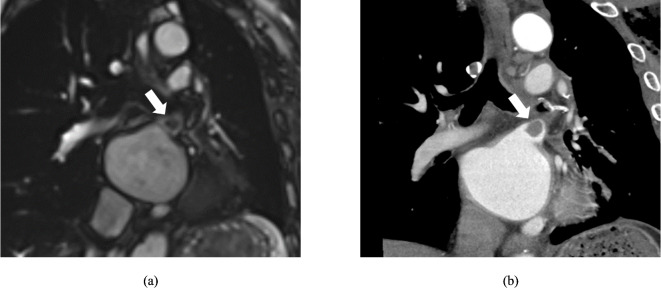 Association between left atrial function and pulmonary vein stump thrombus after left upper lobectomy: insights from cine-MRI.