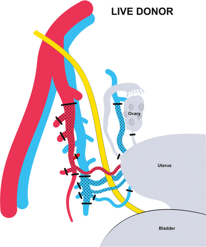Uterus transplantation: A clinical breakthrough after systematic preclinical research.