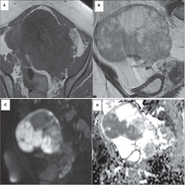 Unenhanced magnetic resonance imaging for the evaluation of sonographically indeterminate ovarian and adnexal masses.