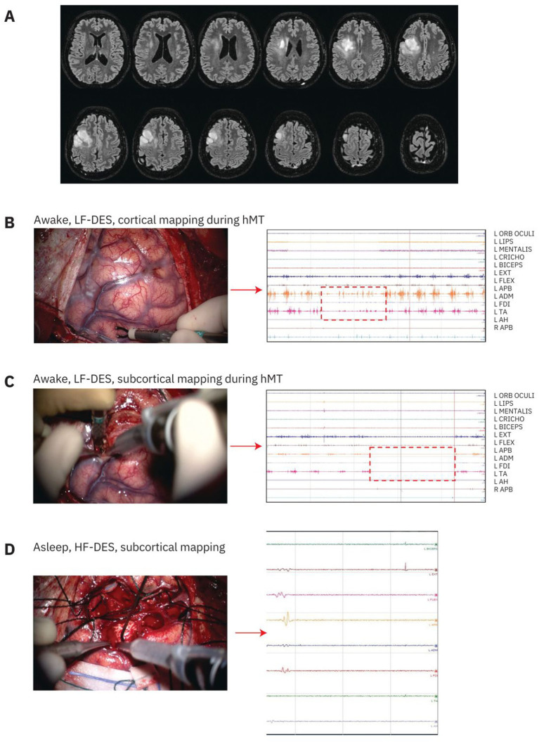 From non-human to human primates: a translational approach to enhancing resection, safety, and indications in glioma surgery while preserving sensorimotor abilities.