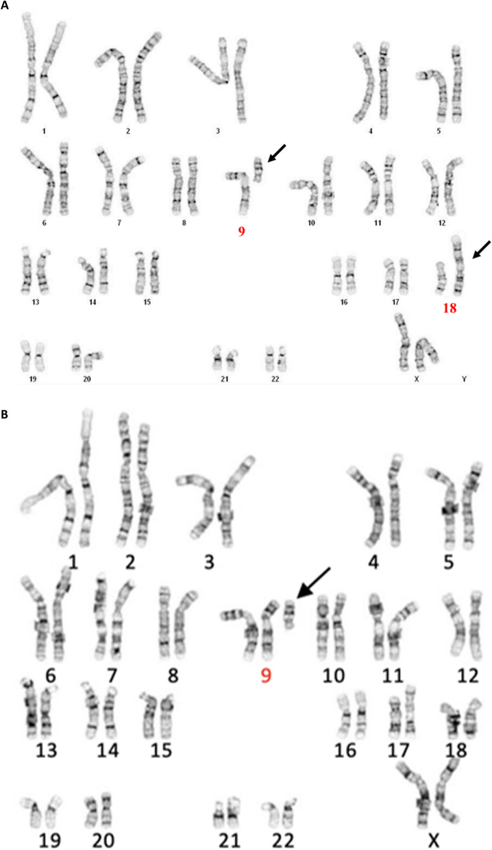 Phenotypic and genotypic insights into concurrent tertiary trisomy for 9p and 18p.