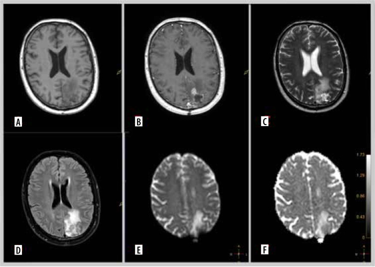 Diffusion imaging in gliomas: how ADC values forecast glioma genetics.