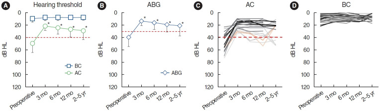 Long-Term Surgical Outcome of Canal-Tympanoplasty in Patients With Schuknecht Type B Congenital Aural Stenosis.