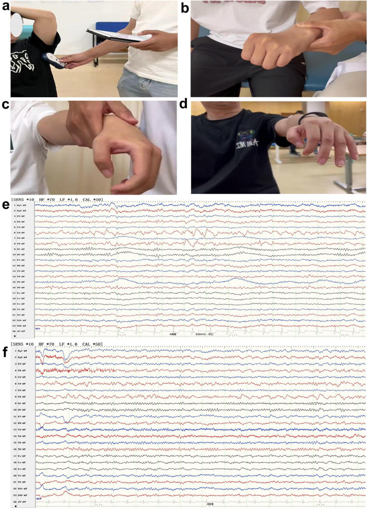 Vagus nerve stimulation combined with nerve rehabilitation therapy for upper limb paralysis after hemorrhagic stroke: a stroke-related epilepsy case.
