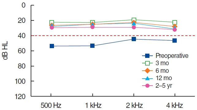 Long-Term Surgical Outcome of Canal-Tympanoplasty in Patients With Schuknecht Type B Congenital Aural Stenosis.