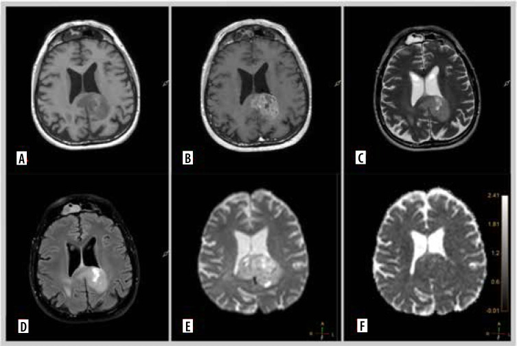 Diffusion imaging in gliomas: how ADC values forecast glioma genetics.