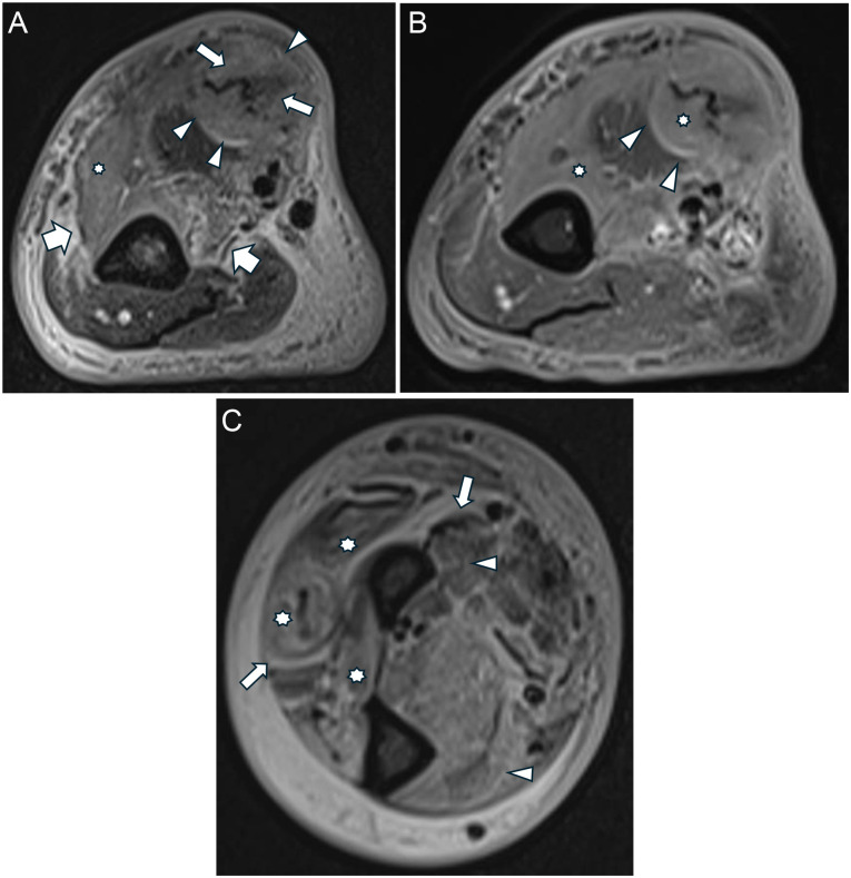 Tuberculous Necrotizing Fasciitis in a Patient with Rheumatoid Arthritis on Anti-TNF Treatment: A Case Report.