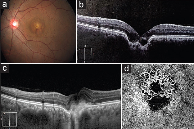 Double focal choroidal excavation with choroidal neovascularization.