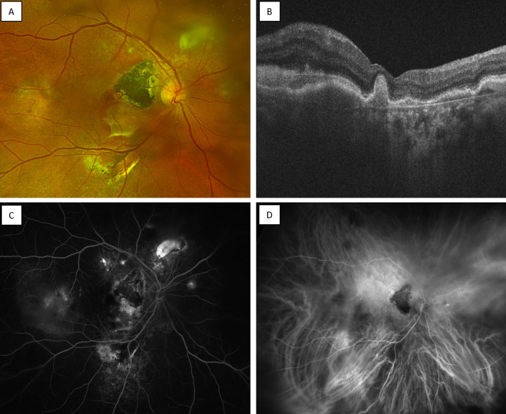 Imaging in Pachychoroid Disease