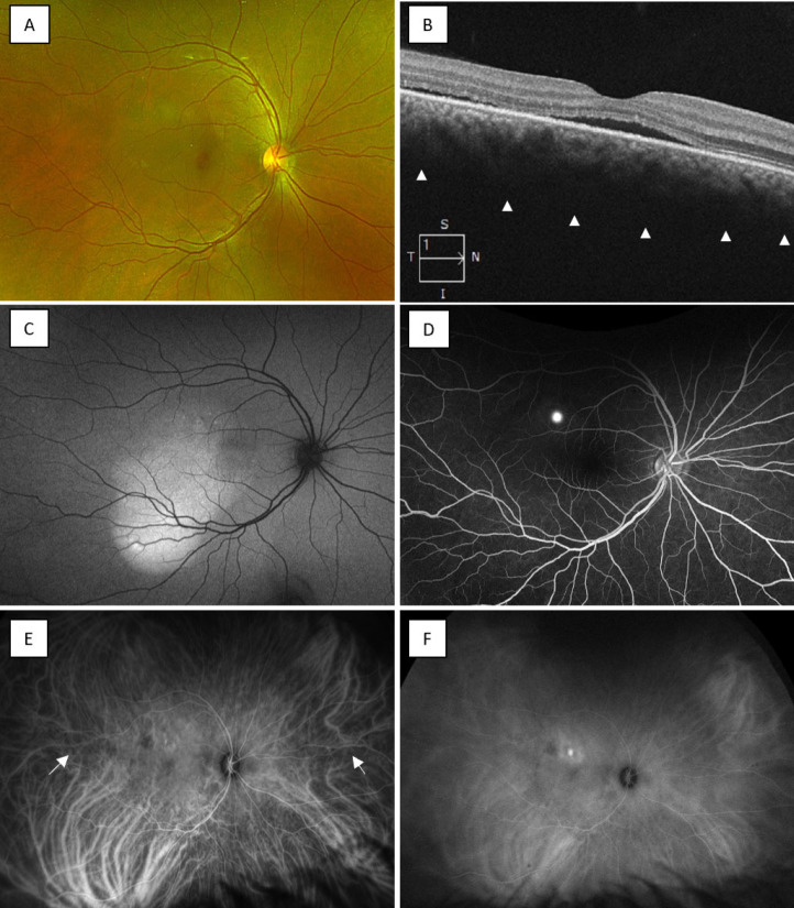 Imaging in Pachychoroid Disease