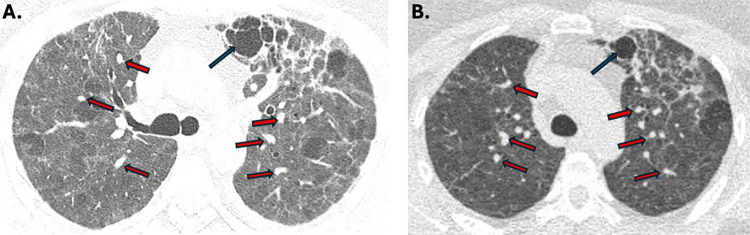 First documentation of Aspergillus welwitschiae in COVID-19-associated pulmonary aspergillosis in the Americas.