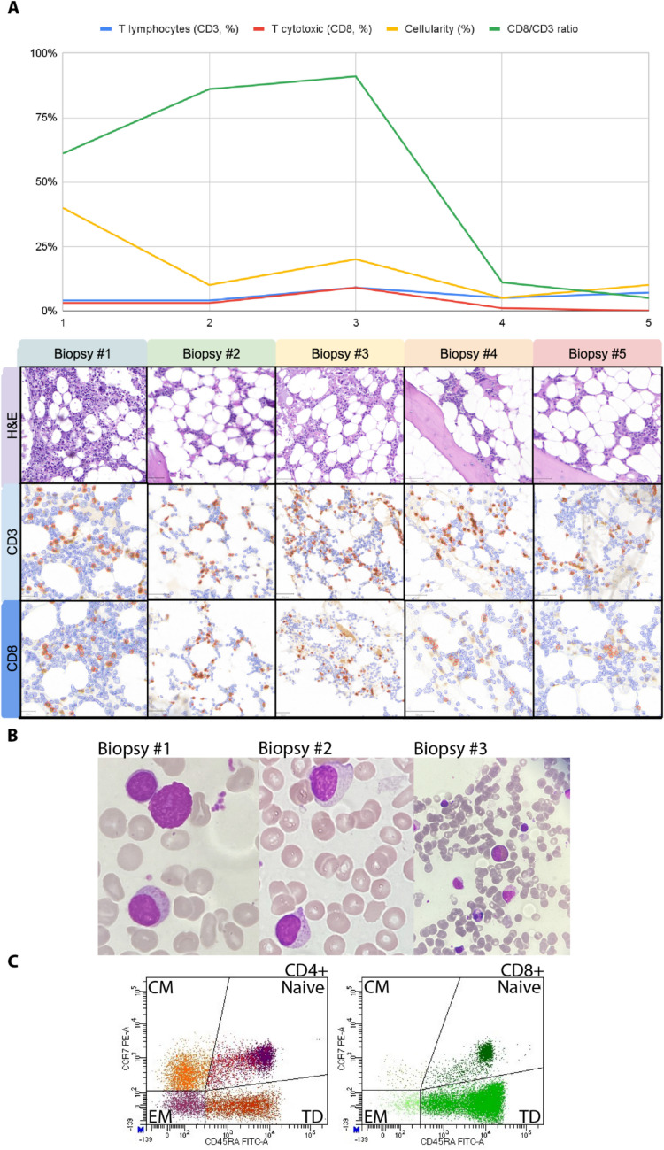 Bone Marrow CD8 + Abundance Inversely Correlates with Progressive Marrow Fibrosis and Myelodysplastic Evolution in GATA2 Deficiency: Case Report.
