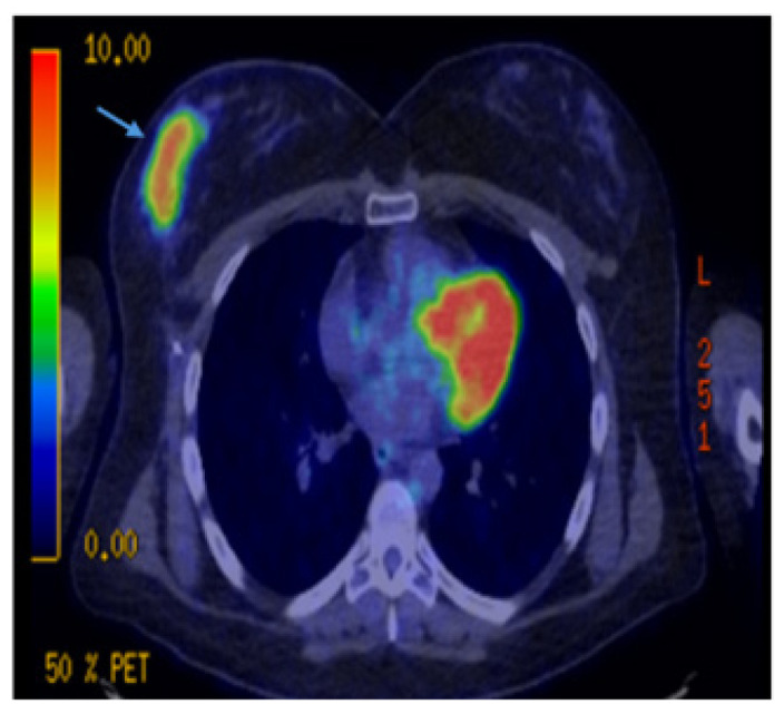 Uncommon Presentation of Metastatic Melanoma to the Breast.