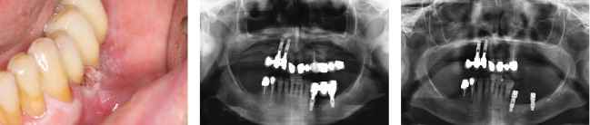 Oral Squamous Cell Carcinoma in Atrophic-Erosive Lichen Planus: 10-Year Rehabilitative Case Report.