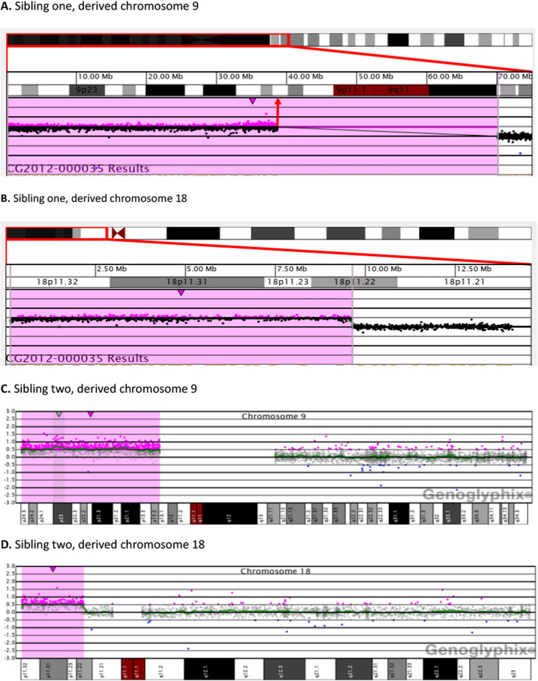 Phenotypic and genotypic insights into concurrent tertiary trisomy for 9p and 18p.