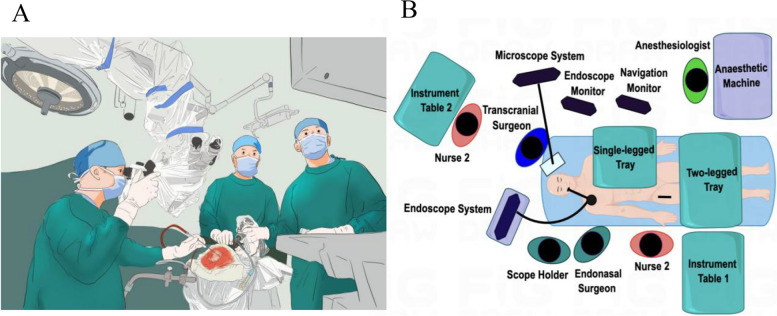 Giant and irregular pituitary neuroendocrine tumors surgery: comparison of simultaneous combined endoscopic endonasal and transcranial and purely endoscopic endonasal surgery at a single center.