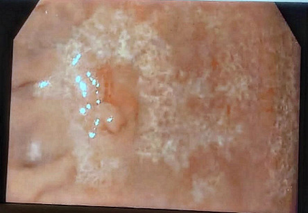 Not Every Headache Warrants a Head CT: A Recurrent Headache Unveiling H. Pylori-Positive MALToma.