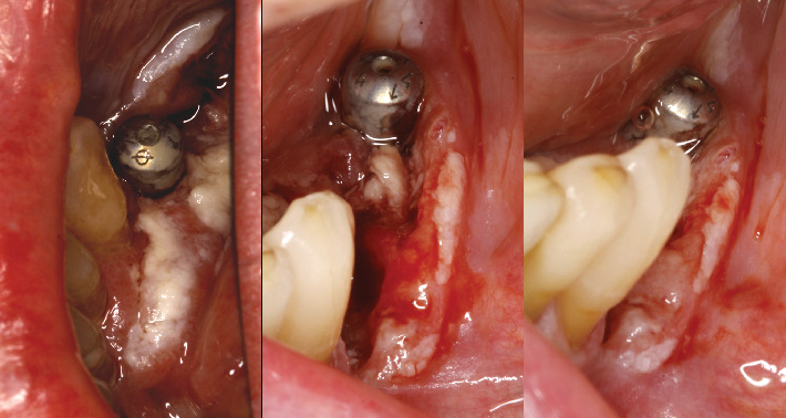Oral Squamous Cell Carcinoma in Atrophic-Erosive Lichen Planus: 10-Year Rehabilitative Case Report.