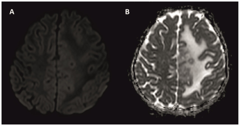 A rare and challenging pediatric case of drug toxicity and immune reconstitution inflammatory syndrome during the treatment of intracranial tuberculoma: A case report.