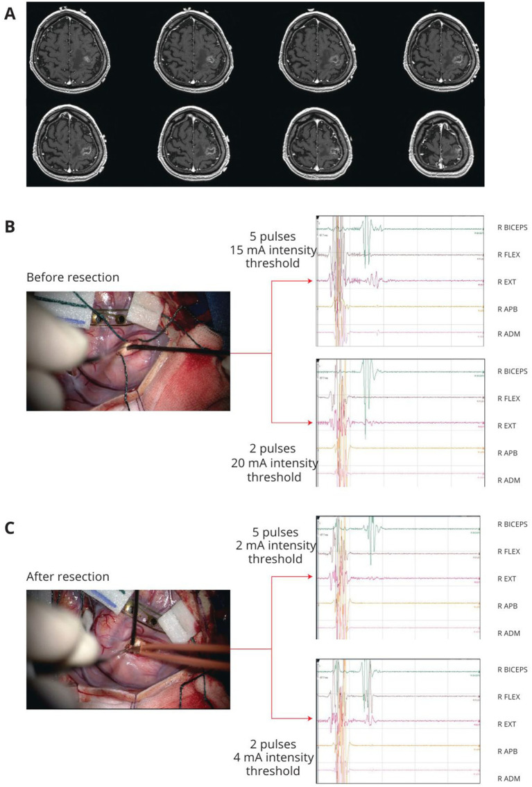 From non-human to human primates: a translational approach to enhancing resection, safety, and indications in glioma surgery while preserving sensorimotor abilities.