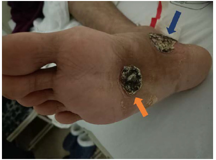 Lues maligna in a patient living with HIV: A case report.