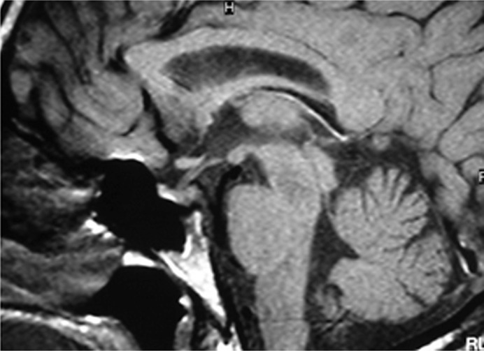 Central Diabetes Insipidus in Father and Son Linked to a Rare Variant: A Case Report.