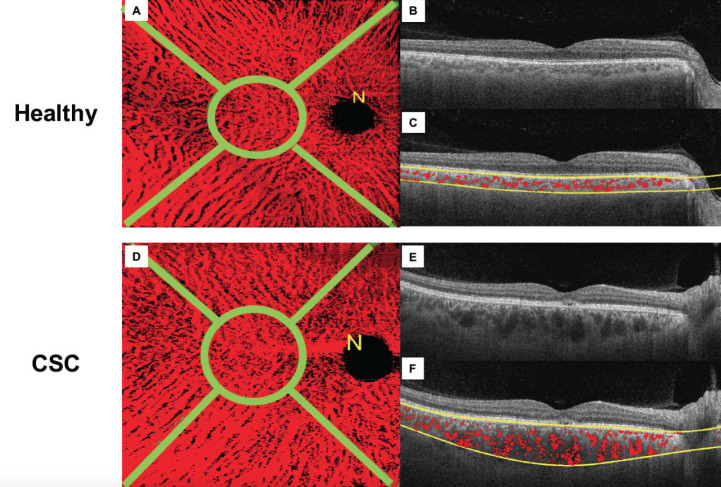 Imaging in Pachychoroid Disease