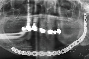 Oral Squamous Cell Carcinoma in Atrophic-Erosive Lichen Planus: 10-Year Rehabilitative Case Report.