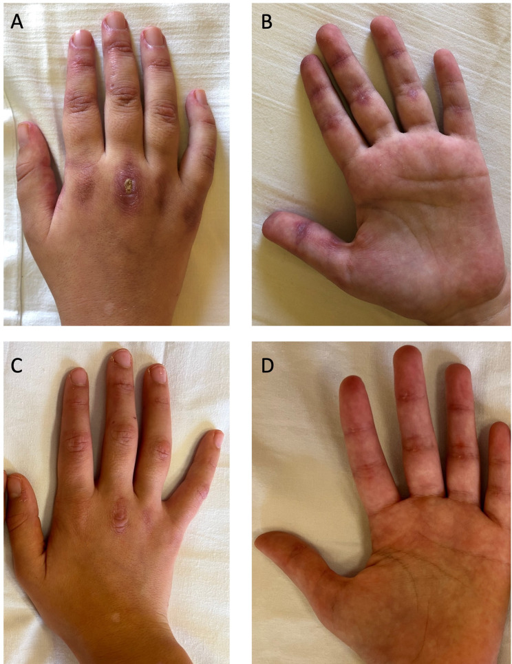 Successful treatment of an anti-MDA5 antibody-positive Juvenile Dermatomyositis patient with refractory interstitial lung disease using tofacitinib.