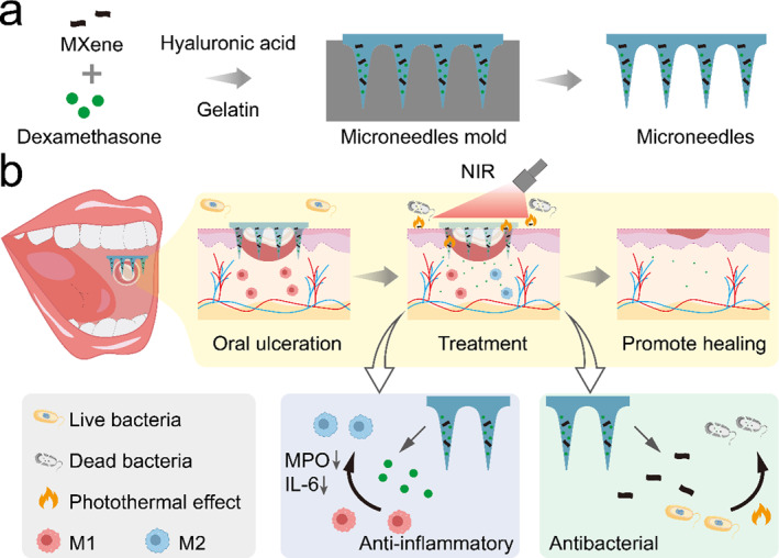 MXene-Integrated Responsive Hydrogel Microneedles for Oral Ulcers Healing.