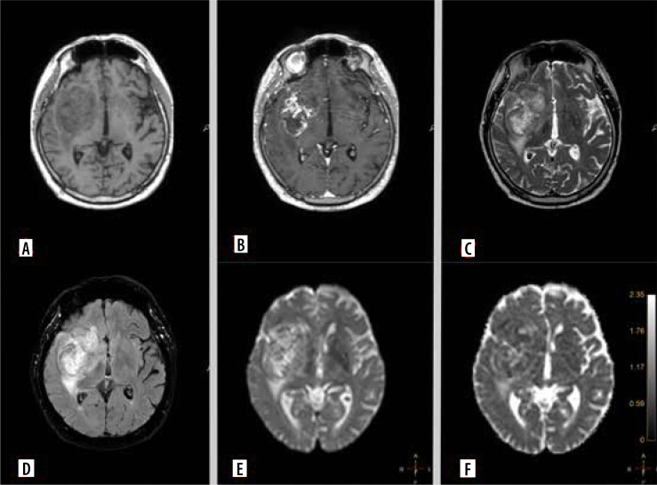 Diffusion imaging in gliomas: how ADC values forecast glioma genetics.