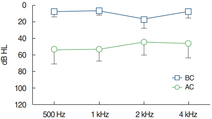 Long-Term Surgical Outcome of Canal-Tympanoplasty in Patients With Schuknecht Type B Congenital Aural Stenosis.