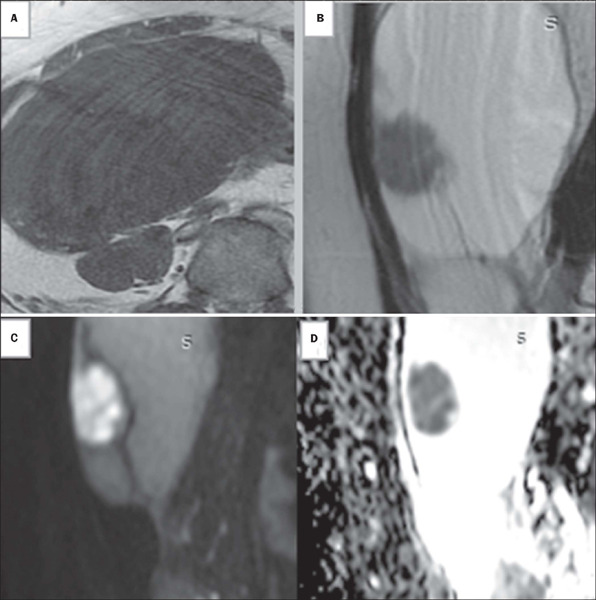 Unenhanced magnetic resonance imaging for the evaluation of sonographically indeterminate ovarian and adnexal masses.
