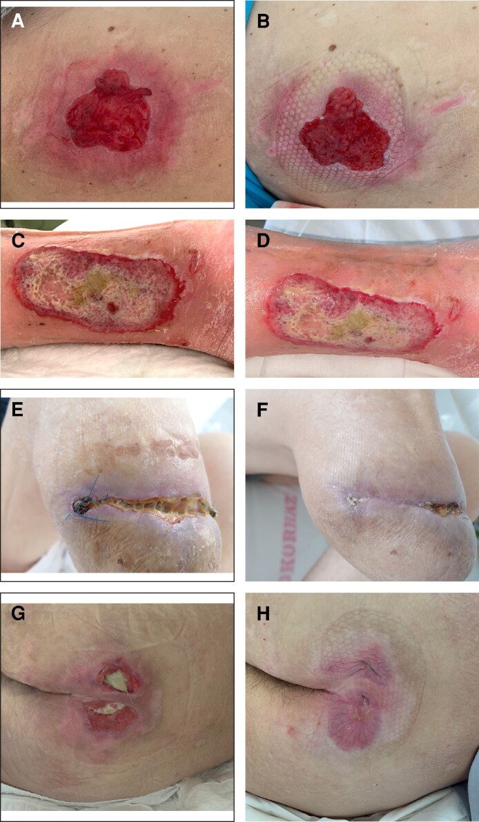 The Use of a Proprietary Near-Infrared Laser to Enhance Wound Healing: A Preliminary Preclinical and Clinical Study.